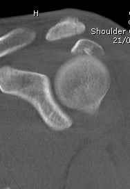 CT Coronal Greater Tuberosity Fracture